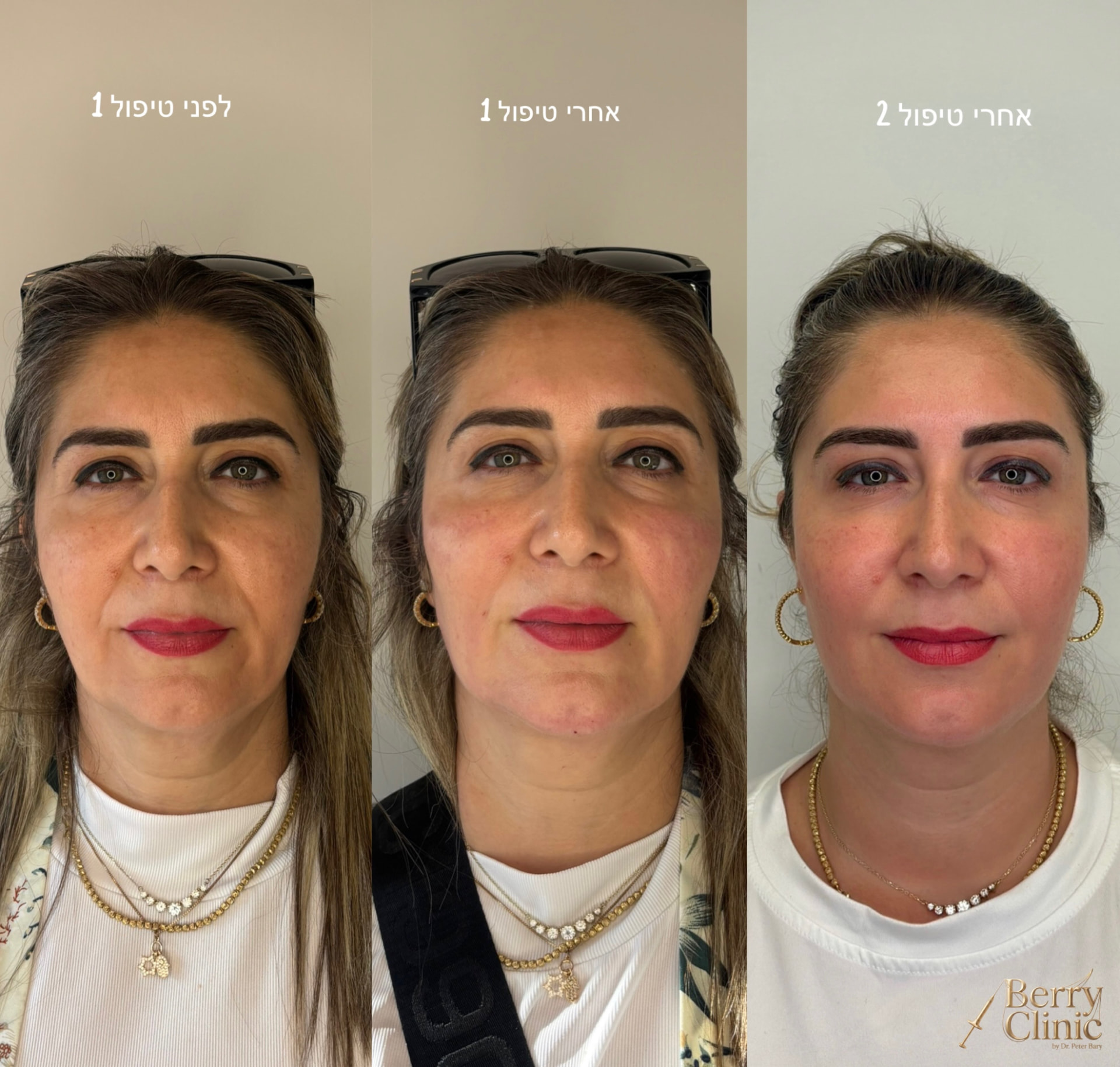 תהליך מדורג · אחרי טיפול ראשון ושני