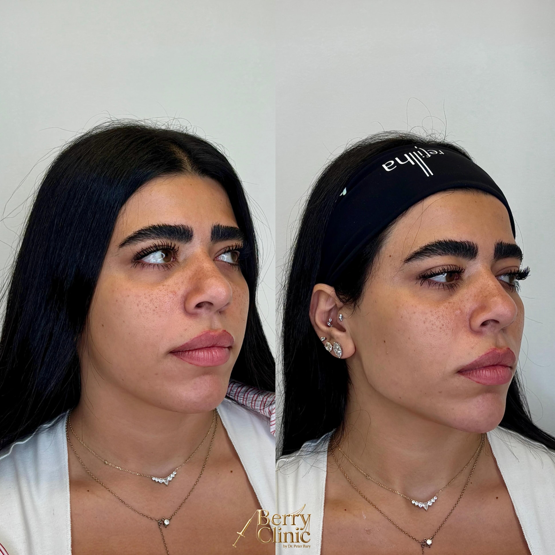 הגדרת לחיים וקו לסת